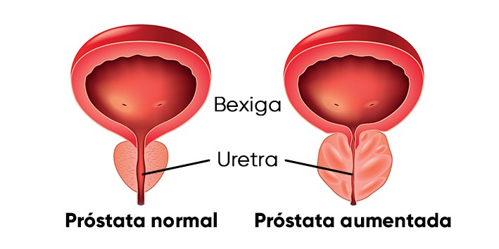 Hiperplasia ou prostata aumentada